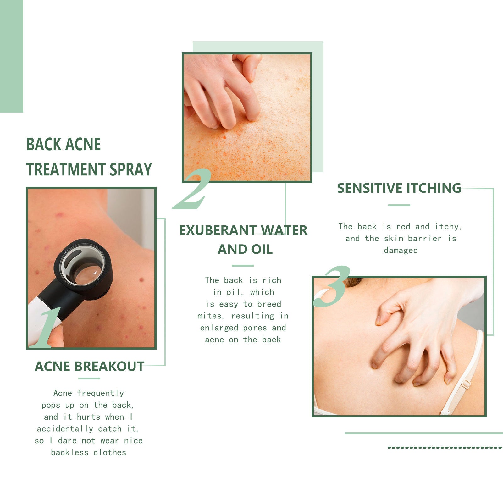 Back Acne Treatment Spray