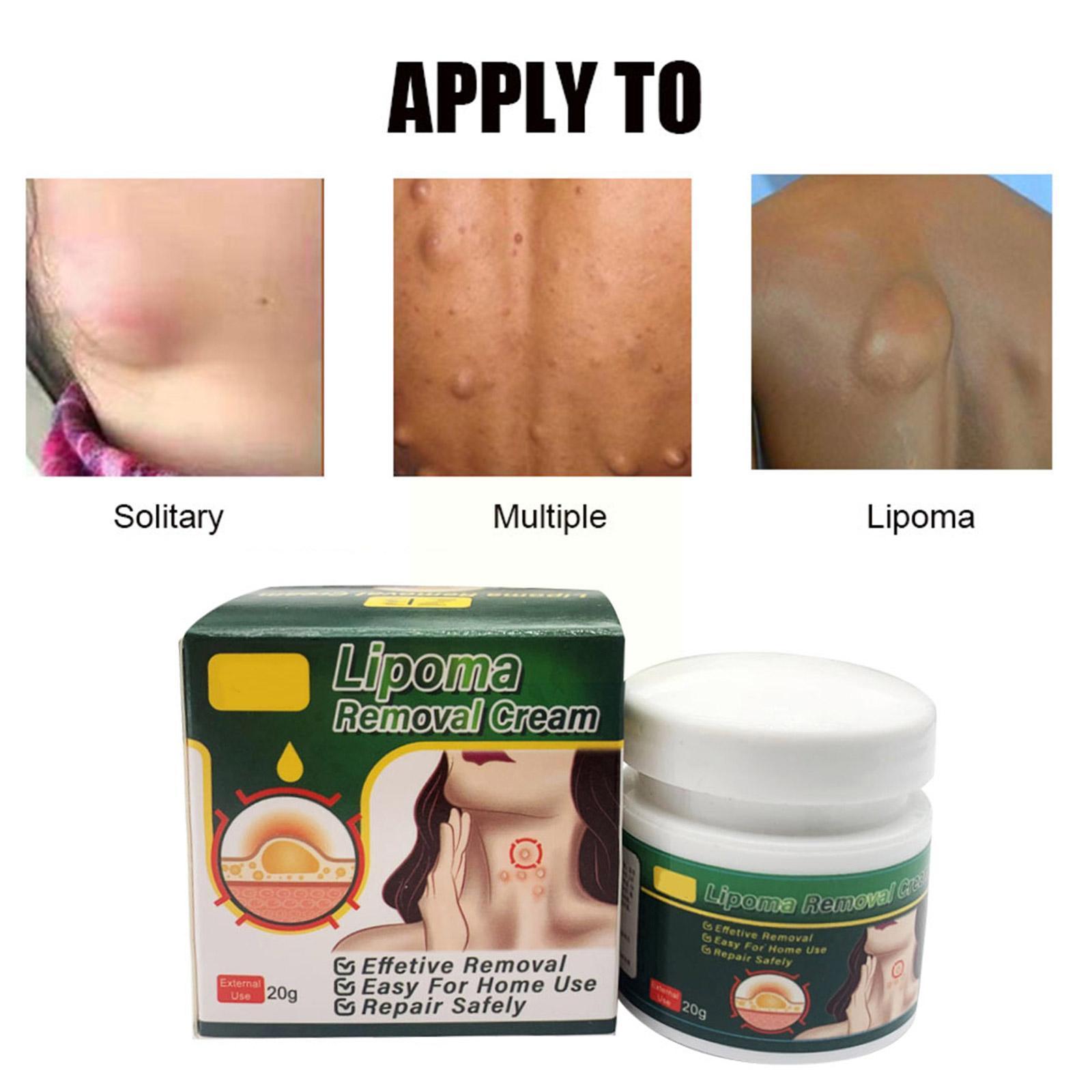 Multiple Anti-tumor Lipoma Pain Cream